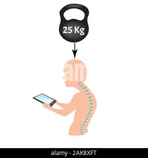 Falsche Körperhaltung Symptome. Text Hals Syndrom. Krümmung der Wirbelsäule, Kyphose, Lordose, Skoliose, Arthrose. Falsche Körperhaltung und Bücken. Infografiken Stock Vektor