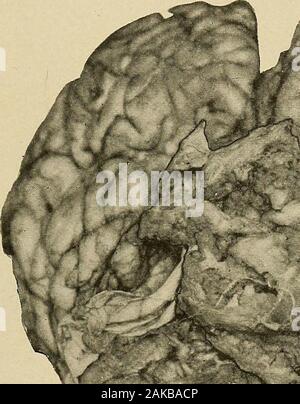 Erkrankungen des Nervensystems: ein Lehrbuch der Neurologie und Psychiatrie. chordomata, lipomata, enchondromata, angiomata, osteomata, adenomata, cholesteomata, teratomata (zirbeldrüse), 2 anddermoids gehören zu den Raritäten. Jelliffe und Larkin, Journal der nervösen und geistigen Krankheiten, Januar, 1912. 2 Bailey und Jelliffe, Tumoren der Zirbeldrüse Körper, Arch w. Int. Med., Dezember, 1912. ANEURISMAL TUMOREN 495 2. Ansteckende Tumoren. - Diese Tuberkulöse, syphilitische, actino antimykotischen. Tuberculomata sind wahrscheinlich die häufigste aller Tumoren, certainlyin Kinder (Starr, 193 in 600 Tumoren erfasst). Sie sind extr Stockfoto