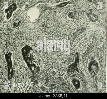 Krebs des Magens; eine klinische Studie von 921 operativ und pathologisch gezeigt. Abb. - (Fall Nr. 21, oo 5). - Photomicrogram vom Rand des tlieulcer, Basen der tubulären Drüsen zeigen frühe carcinomatous ändern (X100).- (Wilson und MacCarty.). Stockfoto