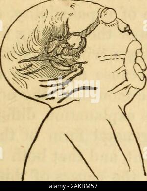 Die Geburtshilfe Memoiren und Beiträgen von James YSimpson;. ICHTHYOSIS INTRA-UTEMNA. 357 cealed von der Haut und nur in deren Umrisse gesehen zu werden sehr imper - fectly; die Augenbrauen waren völlig abwesend; anstelle von geschlossenen Augenlider, gab es zwei blutige Tumoren durch den Innenraum liningmembrane der Augenlider gebildet, oder durch die ectropia der Bindehaut, hinter dem sich die Augäpfel tief in die Umlaufbahnen verborgen waren; therewere aber wenige Wimpern an den Augenlidern, und der extroversion des Con-junctiva weniger Im wurde unter als in den oberen Augenlidern. Abb. 42. Stockfoto