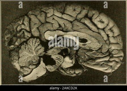 Erkrankungen des Nervensystems: ein Lehrbuch der Neurologie und Psychiatrie. Netzkabel, endet in minderwertigen Oliven, aus denen es besteht direkter (?) zu Deiters Kern, und Kreuze auf die Superior vermis. 1 Horsley, Funktionen des Kleinhirns, Gehirn, 1906, XXIX, 446. 2 Monatsschrift, 1891, I, 104. Zerebellare Syndrome 401 4. Vestibulocerebellar Pfad aus dem Vestibulären Ganglienzellen, whichsends seiner zentralen Fasern an den Zellkern vestibularis und Deitersnucleus im tegmentum, und von dort zu den inferioren vermis. (Die Details dieser Bahnen sind im Kapitel thevestibular Funktionen, auch Stockfoto