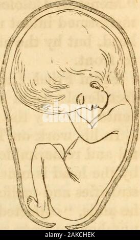 Die Geburtshilfe Memoiren und Beiträgen von James YSimpson;. -Uterinen Erkrankungen des Fetus verändern ihre Form. Verschiedene Neigungen des Fetus in utero in der Änderung kündigen, Toa mehr oder weniger, der Form und Gestalt des Säuglings. Aszites, zum Beispiel Spina bifida, Hydrocephalus,&c, diese haben DER FCETUS IN UTERO. 131 Abb. 8. Wirkung. Der intra-uterinen Erkrankungen die Mostcommon ist hydrocephalus (Abb. 8); und takingit als die häufigsten und merkte pathologicalexample, ich werde mich auf die Beweise, dass Iadduce der Auswirkungen von Krankheiten verändern theform des Fötus, havin Stockfoto