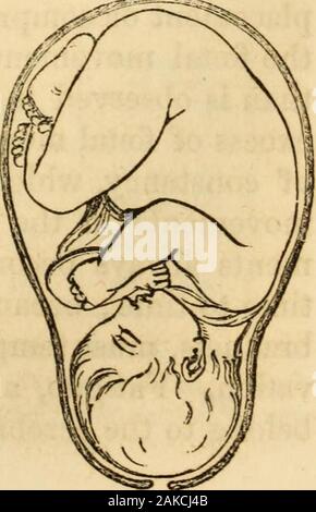 Die Geburtshilfe Memoiren und Beiträgen von James YSimpson;. y 8 ornine Zoll, obwohl dieser Raum, wie der Querachse der theuterine Hohlraum, der fähig ist, Dilatation und gewaltsame Veränderung ofshape werden. An und für die gesamte Laufzeit der utero-Schwangerschaft, die position Fötus mit dem Leiter der niedrigsten ist somit stark von therelative physische Anpassung der ovoide Form der aufgerollten massof der Fötus, die ovoide Form der interiorof der Hohlraum der Gebärmutter gepflegt. Aber diese insbesondere Anpassung und Position des Fötus in theuterine Hohlraum würde oft verloren gehen, wenn keine andere Stockfoto