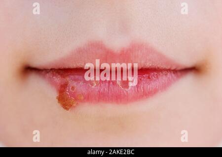 Herpes auf den Lippen des Kindes. Behandlung Salbe. Stockfoto