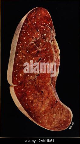 Die Praxis der Kinderheilkunde. ariety bei Kindern selten ist. Auf der anderen Seite, Miliare Tubercu-losis ist eher selten bei Erwachsenen im Vergleich zu den chronischen Form. Carr, der 120 Fälle von Tuberkulose in den Kindern untersuchte, fand heraus, dass 82 wereof Die verbreitet miliare Vielfalt. (Siehe Platte VIII.) Symptome. - miliartuberkulose Auftritt mit relativen frequencyduring Kindheit und Kindheit. Von dem, was bereits über saidconcerning die Pathologie von dieser Krankheit, es ist klar, dass die originalfocus der Tuberkulose kann latent im Organismus für ein gentestgesetz Zeit vor der allgemeinen Infektion occurre wurden Stockfoto