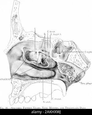 Entwicklung und Anatomie des nasalen Zubehör Nebenhöhlen im Menschen; die Beobachtungen auf zwei Hundert und neunzig seitliche Nasenwände basiert, zeigt die verschiedenen Stufen und Arten der Entwicklung der Zubehör sinus Bereiche aus dem 60. Tag des fötalen Lebens zu fortgeschrittenen Reife. DaysOld. (Serie D, Nr. 76). I^ateral Teile der frontalen, ethmoidal, Kiefer und sphenoidal areashave bjf sagittale Schnitte entfernt wurde. Beachten Sie die markierten Ausmaß der sinussphenoidalis in die Lateralis. Der Grat, auf dem die Sinus sphenoidalis floorof overUes den nervus Canalis pterygoidei (Vidii) gesehen wird. Stockfoto