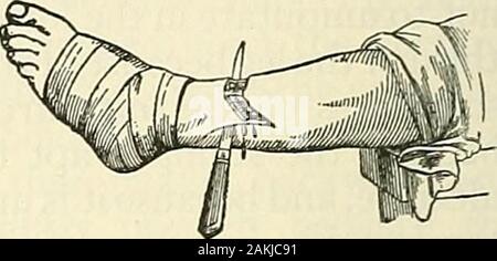 Die moderne Chirurgie, allgemeine und operativen. Abb. Q 83,- S^dillotsamputation des Beines (Wyeth).. Abb. 984.- Amputation des legby Eine lange hintere Klappe (Brutto). Stockfoto