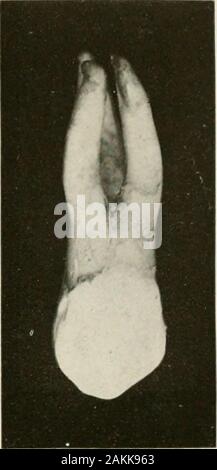 Allgemeine und zahnmedizinischen Pathologie mit besonderer Berücksichtigung der Ätiologie und der pathologischen Anatomie; eine Abhandlung für Studenten und Praktiker. Abb. 161.- Obere firstbicuspid mit drei mots. Stockfoto