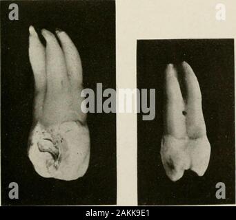 Allgemeine und zahnmedizinischen Pathologie mit besonderer Berücksichtigung der Ätiologie und der pathologischen Anatomie; eine Abhandlung für Studenten und Praktiker. Abb. 159.- Supernumer Abb. 160.- markierten Hy-ary Wurzel in unteren Eckzahn. poplasia der Krone ot alower Eckzahn.. Stockfoto