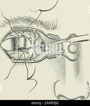 Atlas und Inbegriff der operativen Augenheilkunde. Sagen, die Sehne um 3 bis 5 mm verkürzt wird. Um es in Front zu befestigen, die conjunctivaand subconjunctival Gewebe werden dann mit dem Con-junctival Zange in die Richtung einer zu 6 eingenommen und die needleof dem entsprechenden Ende der Naht als deeplyas durch die Falte gebildet, so dass es sichern - gedrückt wurden in die episcleral Gewebe möglich eingeführt wird. Die Einführung von thesuture ist etwas durch die Tatsache, dass die conjunctivalforceps hat schräge quetschhülsen wThich Projekt über die OX DI OKULÄRE MUSKELN erleichtert. 253 Ziff. Stockfoto