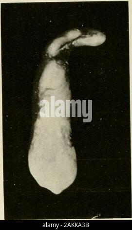 Allgemeine und zahnmedizinischen Pathologie mit besonderer Berücksichtigung der Ätiologie und der pathologischen Anatomie; eine Abhandlung für Studenten und Praktiker. Abb. 155.-distale Durchbiegung einer Ni&gt; pro rechten Eckzahn. Abb. 156. Eine deutliche Abweichung zu themesial in der oberen rechten Eckzahn. Stockfoto