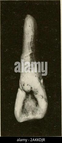 Allgemeine und zahnmedizinischen Pathologie mit besonderer Berücksichtigung der Ätiologie und der pathologischen Anatomie; eine Abhandlung für Studenten und Praktiker. Abb. 137.- Überentwickelt cervicolingual Abb. 139.-Zerklüftete cervicolingual Kante Kante im linken oberen seitlichen Schneidezahn. seitliche Schneidezahn. Stockfoto