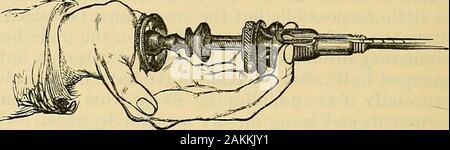 Die Wissenschaft und die kunst der Chirurgie: Eine Abhandlung über die chirurgischen Verletzungen, Krankheiten und Operationen. ^-^^^. Abb. 771.-Position von Hand in mit Civiales Lithotrite. Stockfoto