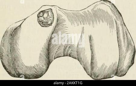 Die Internationale Enzyklopädie der Chirurgie; eine systematische Abhandlung über die Theorie und Praxis der Chirurgie. Resultof Kniegelenk Exzision. Abb. 740. Fitr. 741.. Stockfoto