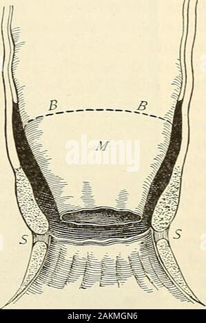 Die moderne Chirurgie, allgemeine und operative. d durch mehr Schmerz, Heilung erfordert eine longertime und striktur ist häufiger. In diesem Betrieb, nach Betäubend, der schliessmuskel dehnen und jedes hemorrhoid gesondert behandeln. Catch a pilewith einer Pinzette oder einem volselliun, ziehen Sie es tun - nn, und schneiden Sie ein gutter durchdie Haut - Marge Wenn der Haufen der gemischten Sorte; die kleinen Stapel withouttransfixing binden, aber Transfix der große Stapel; Riegel mit Seide (grobe Seide für die largepiles, feiner Seide für den kleinen Stapel); Abschneiden jeder Tumor über den Thread andcut die Ligaturen kurz. Behandeln Sie die anderen Stapel in Stockfoto