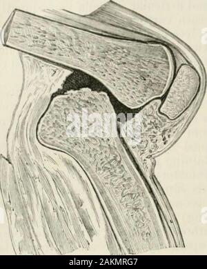 Die Internationale Enzyklopädie der Chirurgie; eine systematische Abhandlung über die Theorie und Praxis der Chirurgie. Erz, Abfall sehr deutlich, die Muskeln, insbesondere theflexors, bald etwas anderes als faserige ^ Schnüre. Die streckmuskeln, Auf der otherhand, die nicht so werden von Reflex tonische Kontraktion aftected, Nor, theretore, l) y Kontraktur, bleiben sie schlaff und ^ sind eher anfällig Degeneration, der aber nicht so früh in der Krankheit auftreten. Aber ein anderer eftect, neben der Flexion, folgt diesen muskulösen wirkt an certainjoints, vor allem am Knie. Denn seit der Knorpel ar Stockfoto