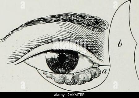 Krieg Chirurgie des faceA Abhandlung über plastische Wiederherstellung nach Verletzungen des Gesichts von John BRoberts.. auf Anregung der Motive auf Kunststoff- und Oralchirurgie mit dem Büro der Chirurg generalIllustrated mit 256 Figuren verbunden vorbereitet. Abb. 245.- Schnitte für Hasners Abb. 246.- Hasners Blepharoplastik olepharoplasty.. durchgeführt. Stockfoto