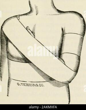 Die Internationale Enzyklopädie der Chirurgie; eine systematische Abhandlung über die Theorie und Praxis der Chirurgie. Dr. Sayres Dressing für gebrochene Schlüsselbein; Anwendung der erste Streifen. Abb. 603. Abb. 604.. Stockfoto