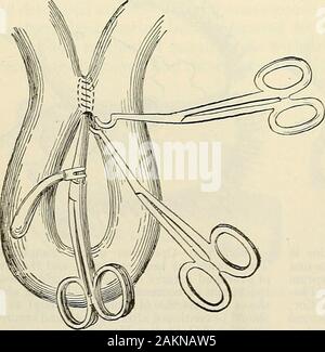 Die moderne Chirurgie, allgemeine und operativen.ly und ordentlich durch thismethod und die wundnaht erfolgt evenand sichern. Die Einwände eines infizierten Instrument arethat iswithdrawn aus dem Darm andmay der Oberfläche verunreinigen, dassdie Septum ist eng squeezedand dieses Septum kann Slough ormay infiziert werden, conditionswhich Per sonen- tion der Wundnaht; und thatcontraction der Kragen kann en-Sue. Die Bedienung ist mehr Hableto gefolgt von Leckage oder obstructionthan bypartial oder abgeschlossen werden, ist der Betrieb ohne für-ceps. Die Zahlen 714 und 715 Illus-gedrückt wurden die Verwendung von Laplaces f Stockfoto