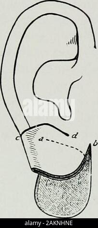 Krieg Chirurgie des faceA Abhandlung über plastische Wiederherstellung nach Verletzungen des Gesichts von John BRoberts.. auf Anregung der Motive auf Kunststoff- und Oralchirurgie mit dem Büro der Chirurg generalIllustrated mit 256 Figuren verbunden vorbereitet. Abb. 217. Abb. 218. Stockfoto