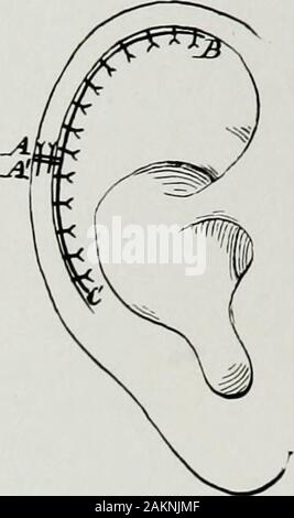 Krieg Chirurgie des faceA Abhandlung über plastische Wiederherstellung nach Verletzungen des Gesichts von John BRoberts.. auf Anregung der Motive auf Kunststoff- und Oralchirurgie mit dem Büro der Chirurg generalIllustrated mit 256 Figuren verbunden vorbereitet. Abb. 215.-Methode der Instandsetzung der Ohrmuschel, wenn sie notwendig sind, um ein lacer- Teil der Verbrauchsteuer oder eine Wunde zu reparieren. Stockfoto