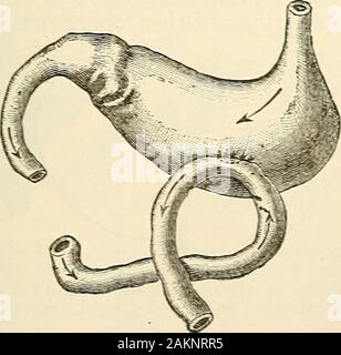 Die moderne Chirurgie, allgemeine und operativen. Abb. 660.-Bi] lrotlis methodof gastro-enterostomy.. Stockfoto