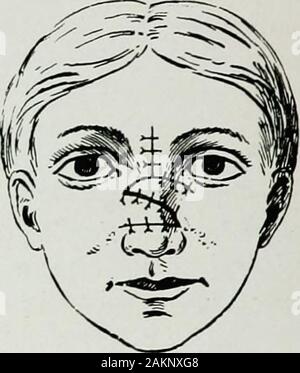 Krieg Chirurgie des faceA Abhandlung über plastische Wiederherstellung nach Verletzungen des Gesichts von John BRoberts.. auf Anregung der Motive auf Kunststoff- und Oralchirurgie mit dem Büro der Chirurg generalIllustrated mit 256 Figuren verbunden vorbereitet. Fie. 186.. Abb. 188. Abbn. 185, 186, 187 und 188.- Robertss Verfahren zum Betrieb auf dem sunkennose durch überlagerte Karten von Wange und nasofrontal Regionen. Und dass der linken Klappe eingeschaltet ist, um auf eine pointnear der inneren canthus des rechten Auges erreichen. Nähte werden employedto Aufrechterhaltung der neuen Beziehungen Der frontonasal Klappen, die Stockfoto