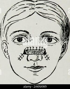 Krieg Chirurgie des faceA Abhandlung über plastische Wiederherstellung nach Verletzungen des Gesichts von John BRoberts.. auf Anregung der Motive auf Kunststoff- und Oralchirurgie mit dem Büro der Chirurg generalIllustrated mit 256 Figuren verbunden vorbereitet. Abb. 187.. Fie. 186. Stockfoto