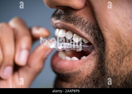 Close-up In eines Mannes Hand Transparent Ausrichter in Zähne Stockfoto