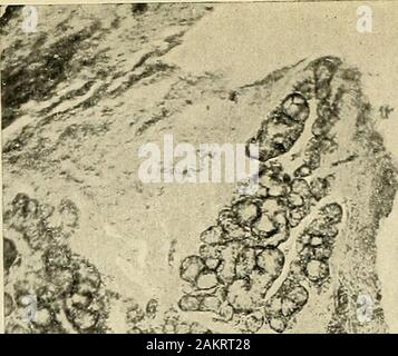 Grundsätze und Praxis der Operative Zahnheilkunde. ^"^ Abb. 202.-Oblique Abschnitt der zahnmedizinischen Follikel und Schleimhaut. (V. A. in Latham, ich. Stockfoto