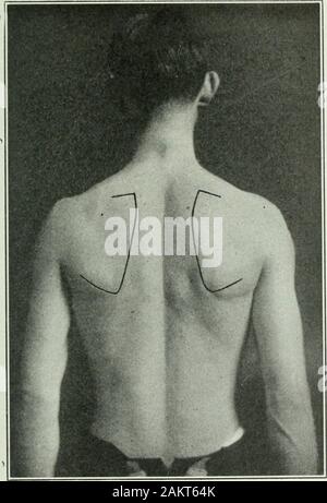 Angewandte Anatomie und Kinesiologie; der Mechanismus der Muskelbewegung. ullheight; aber das Gewicht des Arms allein ist ein vergleichsweise smallelement im Falle derjenigen, die arm sind miable straightup zu setzen. Zunächst ist es nicht vor allem die schwächeren individualswho nicht die vollständige Bewegung zu machen; das Gewicht der armacts am effektivsten auf die horizontale Position und hat weniger effectabove Es, während die größte Schwierigkeit diese Subjekte erfahren inraising den Arm nicht beginnen, bis es deutlich höhere thanshoulder Ebene; die Schwierigkeit ist nicht durch themovemen entfernt Stockfoto