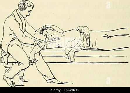 Die moderne Chirurgie, allgemeine und operativen. Abb. 404. - Verringerung der Schulter - gelenkluxation durch das Knie in theaxilla (Cooper). Abb. 405.- Reduktion der Schulter - gelenkluxation durch up-Station Extension (Cooper). Riemenscheiben shotild nicht verwendet werden, um die Knochen in die richtige Position zu ziehen, da Sie Adangerous Kraft entwickeln. In einer Dislokation irreduzible durch gewöhnliche Kraft, antisepticincision ist sicherer und besser als die Riemenscheiben. Nach der Inzision versuchen thebone wiederherzustellen. Bei der Verringerung der Dislokation der axillären Arterie oder Vene gebrochen werden kann, Bruch der Hals des himierus kann stattfinden, Schädigung des brachialplexu Stockfoto