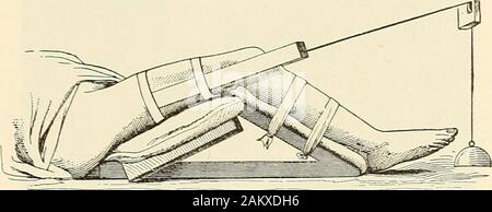 Die moderne Chirurgie, allgemeine und operative. Els. Infracture aus dem oberen Drittel der oberen Fragment ist apt stronglyforward und nach Außen (Abb. geworfen zu werden. 352). Der Aktion der Frakturen des Femurs 595 psoas, Iliacus und externe Rotator Muskeln, aber Allis denkt, dass es durch die untere Fragment chieflyto Drücken der oberen Fragment in dieser Position, ein teilder Sehne des gluteus maximus als Scharnier für die Fragmente.^ In seltenen Fällen die kantige Mißbildung ist zurück. In Bruch der Welle des Femur es kompletten Verlust der Funktion ist, den Oberschenkel und Stockfoto