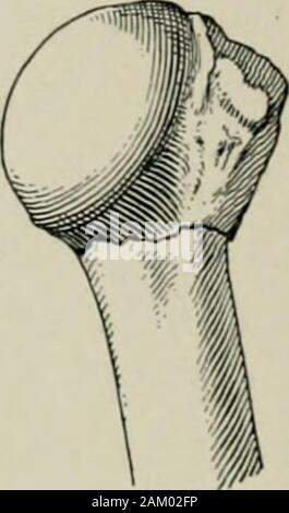 Amerikanische Praxis der Chirurgie: ein vollständiges System der Wissenschaft und die kunst der Chirurgie. Abb. 31.-Frakturen des oberen Ende des tlie Humerus. (Schreiber.) a, Linien der Bruch in der oberen Ende des Humerus (1, Bruch der anatomischen Hals; 2, Bruch durch die tuberkel; 3, Bruch des chirurgischen Hals); 6., Fraktur des Humerus unterhalb der Tuberkel, mit Entführung des Arm- und Einschlag der gebrochenen Enden der Knochen. Ansicht von vorne: c, Bruch Eigenprojekt durch die tuberkel und auch über die anatomischen Hals des Humerus (Y-förmigen fracturewith Entführung von Arm und displ Stockfoto