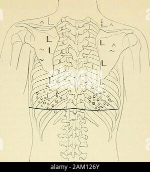 Lehrbuch der klinischen Untersuchungs-Methoden: für praktische Ärzte und Studirende. Abb. 99. Physikalischer Befund bei Katarrhalischer Infarcten Pneumonie, etc. 385. Abb. 100. Physikalisclier Befund bei Diffusor Broncliitis. Stockfoto