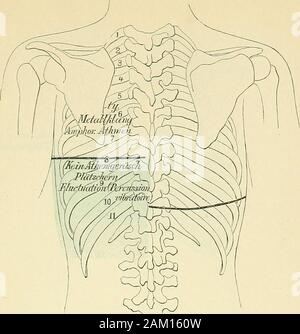 Lehrbuch der klinischen Untersuchungs-Methoden: für praktische Ärzte und Studirende. Physikalischer Befund bei rechtsseitiger exsudativer Pleuritis. 383. Abb. 96. Physikalischer Befund bei liultsseitigem Pyopneumothorax (Vgl. auch Abb. 64, S. 214). Stockfoto