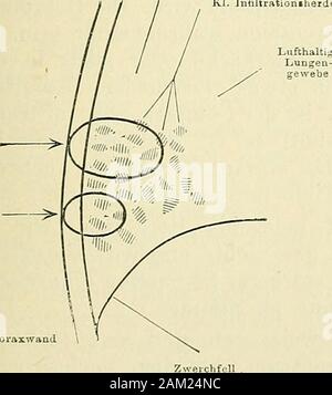 Lehrbuch der klinischen Untersuchungs-Methoden: für praktische Ärzte und Studirende. I. Pleuritisclies Exsudat. ZwerclifoU II. Oberfläcliliclier Infiltrationsherd. Kl. Inflltrationiherde. Iii. Kleine disseminirte Infiltrationsherde. u AViikungssphäre krasser, & schwacher Percussion. Stockfoto