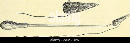 Chirurgie journalière des Hopitaux de Paris: Répertoire de thérapeutique chirurgicale. Il est dun Avis opposé tout.- Lurèthre de la Femme est Très-Flüssigkeit mit spezifischer Volumenänderung et ne présente pas Geb. - stacle sérieux au Passage du lithotriteur; Mais, cependant comme lefait remarquer M. Reliquet, ce Canal, en raison de sa Verfassung, est le Siège de spasmes fréquemment énergiques, surtout lorsquil ya une Reizung constante de la vessie déterminée par la présence decalculs. Selon M. Reliquet, Les difficultés de la manuelles lithotritiepropre à la Femme sind Beiträge: 1° ein lexistence De spasmes vésico - uréthrauxou à Stockfoto