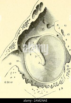 "Traité d'anatomie humaine. une petite Ausgrabung, qui fait Partie de la Caisse et à laquellePrussak a donné Le nom de poche supé-rieure de la Folie du Tympan, Trôltsch eine décrit sur la Face interne de lamembrane du tympan deux autres dépres-sion ou poches: Lune, pocheantérieure antérieure de Trôltsch immédiate-, située au-dessus du Ligament tympano-malléùlaire antérieur; lautre postérieure, poche postérieure de Trôltsch, souvrantau-dessous du Ligament tympano-malléo - laire postérieur. Cest au-dessus de cettedernière, Immédiatement en arrière dumarteau, que se trouve lentrée de la pochesu Stockfoto