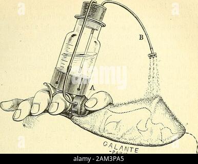 Chirurgie journalière des Hopitaux de Paris: Répertoire de thérapeutique chirurgicale. Abb. 352. - Appareil à anesthésie de Demarquay (Premier modèle). 3° Ne Pas faire Inspirator une trop Grande quantité de chloroforme àla fois; mez Agent doit être donné Dune façon Lente, fortfahren, nonbrusque, tombant Goutte à Goutte, et mélangé à-Höhle. 4° Éviter, par cette Dernière précaution, Irritante laction duchloroforme sur les cavités muqueuses des de la Face et sur Celles dularynx et de la trachée, ce Kontakt étant très - causede probablement La La Période dexcitation. - Afin de satisfaire à ces Anzeige Stockfoto