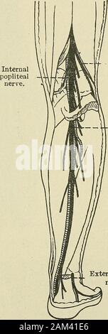 Medizinische und chirurgische Therapie. Interne Zweig der niusculo-kutane.. Externalpoplitealnerve. Hintere Kopfeinheit tibialnerve. Externe saphenousnerve. Abb. 64-muskulo-kutane andanterior Tibialis. Abb. 65.- Interne poplitea andposterior Tibialis. Die große Ischias, von der oberen Winkel der A. poplitea Raum entsteht. Es führt entlang der Sehne des theijiceps und hinter dem Kopf von inding thefibula, * um den Hals der Knochen, das ist der Ort, an chosenfor Palpation dieser Nerv, und endet dann durch Division innerhalb der vorgeschriebenen Einfügungen Der peroneus longus (Abb. 64). 156 KLINISCHEN FORMEN VON N Stockfoto