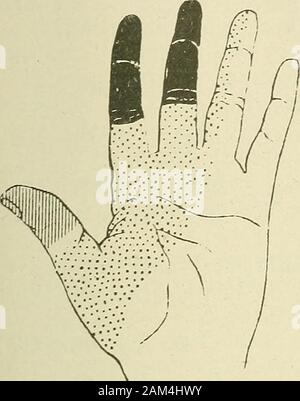 Medizinische und chirurgische Therapie. RVE Läsionen der Muskeln ist in einem solchen Ausmaß thatin einige Monate Zeit, die Nerven und die Muskeln Oberflächliche zervikalen Plexus akzentuiert. Oircumflei. Interkostalen. Stütz-Spirale. Weniger interne Kutane. - Interne kutane - {Muskulo-kutane. ? Ulnare. Radiale. Median (Palmar kutane Nerv) Med Ian (collateral Nerven der Finger) Ulnaren •, (oberflächliche terminal Zweig). Abb. 22.- periphere sensorische Verteilung der oberen Extremität (anterior Aspekt). sind der Meinung sein entweder unterbrochen oder Konstantenstrom. Sensorische Störungen. - Die sensorische Veränderungen Form aninterest Stockfoto