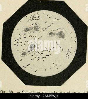 "Traité pratique de bactériologie. Érations nettement syphilitiques, eten Association avec Le Bacille de Loeffler dans les fausses membranesdiphtériques. Auf doit peut-être Lui le rapporter Bacilhis fusiformis, isolé parVeillon et Zuber de Eiter dappendicite (s. 57). Silberschmidt (2) Ein trouvé le Bacille fusiforme Associé aux Spirillesdans le pus Dun abcès de la cuisse, avec des Mikroben pyogènes. BACILLE DE LA BALANITE DE VINCENT. Auf doit rapprochre des espèces préc édentes, en raison de la similitudedes lésions observées et sur-tout de lassociation symbio-tique avec des Formes spiril - laires, un Stockfoto