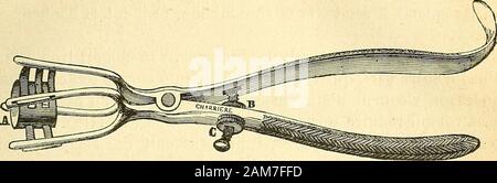 Chirurgie journalière des Hopitaux de Paris: Répertoire de thérapeutique chirurgicale. roduire une Bruch pour faire latête à repasser sa statt. 2° Impulsion directe. - Jugeant Quoique la Meilleure, ce chirurgienla regarde Encore comme Bien imparfaite. Elle repousserla consiste à la Falange en faisant glisser sur le métacarpien. Dans cette ma-noeuvre, il faut se rappeler que Cest la Falange que Lon doit cher-cher à mouvoir, et on ne doit pas sépuiser en Anstrengungen inutiles sur latête du métacarpien qui, Lui, ne peut être considéré comme luxé: ce Letzte os na pas bougé, La mesz Falange qui s Stockfoto