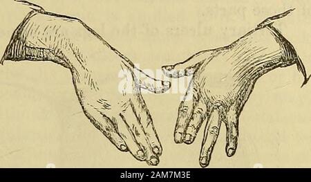 Ein System der Chirurgie. Auf runden thishad führte zu einer Perforation des Schädels und des tödlichen Meningitis. Knoten sind häufig an und die Befestigung von importantmuscles bis auf die Knochen einzubeziehen; damit die Einfügung der Masseter muscle andie Unterkiefer, die Herkunft des Pectoralis major vom Schlüsselbein, Brustbein und Rippen, die sterno-mastoid vom Schlüsselbein, die Magen-darm-cnemius aus Femur (Oberschenkelknochen), sind alle eher bevorzugten Websites für solche nodesor gummata. Die häufige Belastung der Muskeln auf der periosteumhas sehr wohl etwas mit der Tatsache zu tun. Nur wenige können sich, wenn überhaupt, der langen Knochen, ausgenommen fr sein Stockfoto