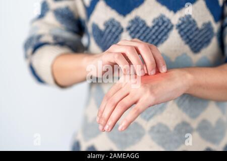 Junge Frau zerkratzt ihre juckende Hand. Konzept Hautproblem, Allergie und Dermatologie Stockfoto