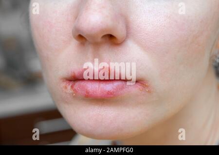 Herpes-Virus an den Lippen der jungen Frau. Peeling und verbleibende Blasen auf der Haut. Stockfoto