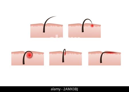 Eingewachsene Haare nach der Depilation. Vektorgrafiken. Hautstruktur. Stock Vektor