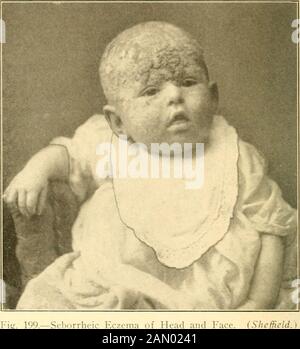 Moderne Diagnose und Behandlung von Krankheiten der Kinder; eine Abhandlung über die medizinischen und chirurgischen Erkrankungen der Kindheit und Kindheit der Kindheit. Das Ekzem von Gesicht und Kopf ist bei Kleinkindern usuallyseen und zur Behandlung sehr refraktär. INITS typische Form, der Ausbruch des Ekzema faciei ist im Allgemeinen spokenof als crusta lactea, und besteht aus mehr oder weniger zusammenhängenden Skabs {^Tee!von grünlicher oder schwärzlichbrauner Farbe, hier und tbere unterbrechtedby Bereiche von Rot, feucht (weinende Oberfläche), Und exkoriierte Haut. Vom Gesicht reicht die Eruption normalerweise bis zur Stirn, zum Ohrensandkopf (Ekzem oder Seborrhea Stockfoto