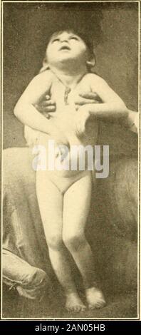 Moderne Diagnose und Behandlung von Krankheiten der Kinder; eine Abhandlung über die medizinischen und chirurgischen Erkrankungen der Kindheit und Kindheit . Aussehen und Geschmack. (Sheffield.) der mongolische Idiot beginnt mit einem viel späteren Alter als das mongoianische - Grad   und plump normale Baby. Seine Gelenke sind schwach, und seine Hände und Füße plump, extremitäteamaurotische Idiokie ist durch muskuläre Atonie gekennzeichnet, die Salz, allmählich in der allgemeinen Lähmung endet. Die Kretin ist apeculiar schleifend und unbeholfen und weist oft Deformi-Binden der Extremitäten und Verdickungen der Gelenke auf. Einseitige orbeidseitige Hemiplegie Stockfoto